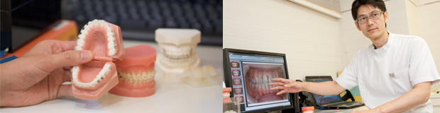 なるべく抜歯しない矯正