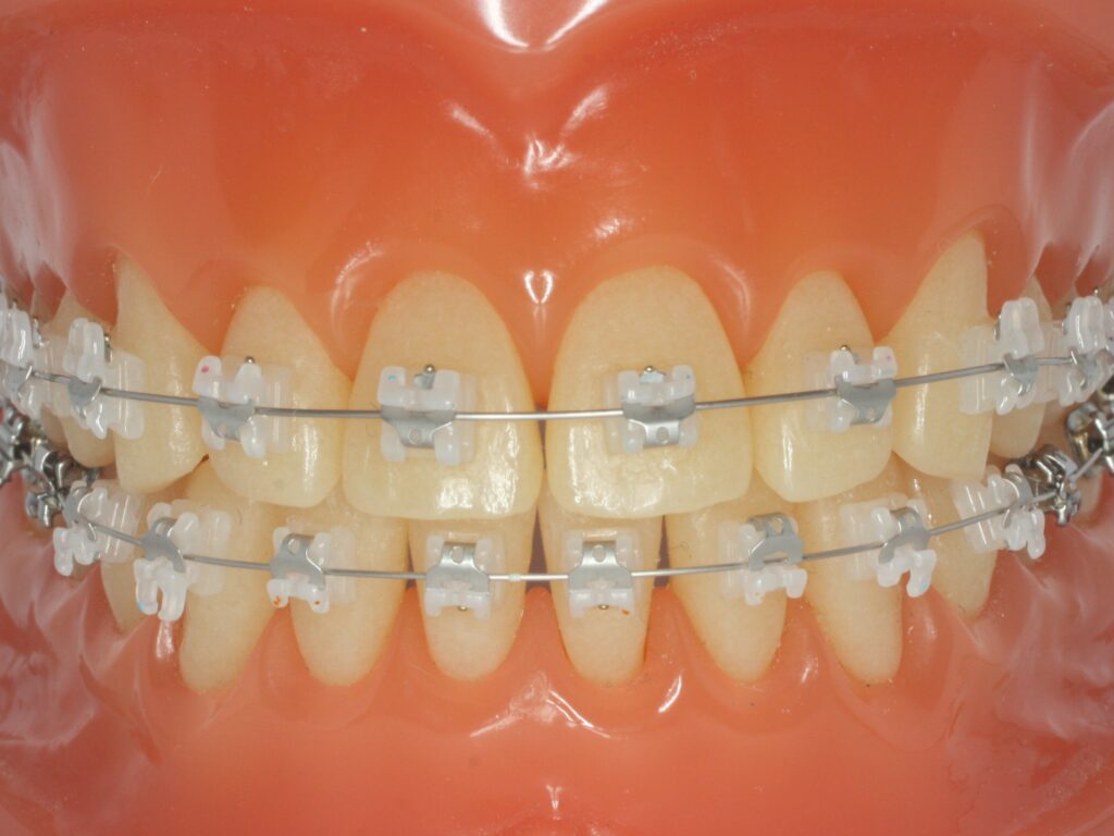 セルフライゲーションブラケット